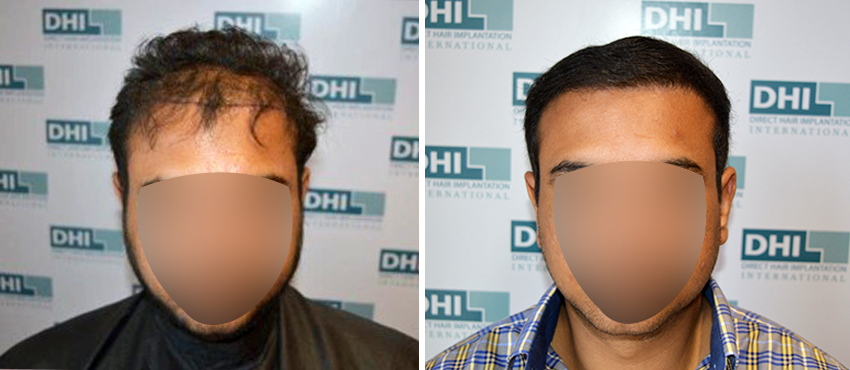 DHI before & after hair transplant results